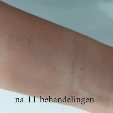 Huid van een arm na 11 behandelingen, met duidelijke verbetering zichtbaar.